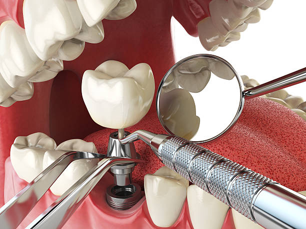 Best Chipped Tooth Repair Near Me  in South Burlington, VT
